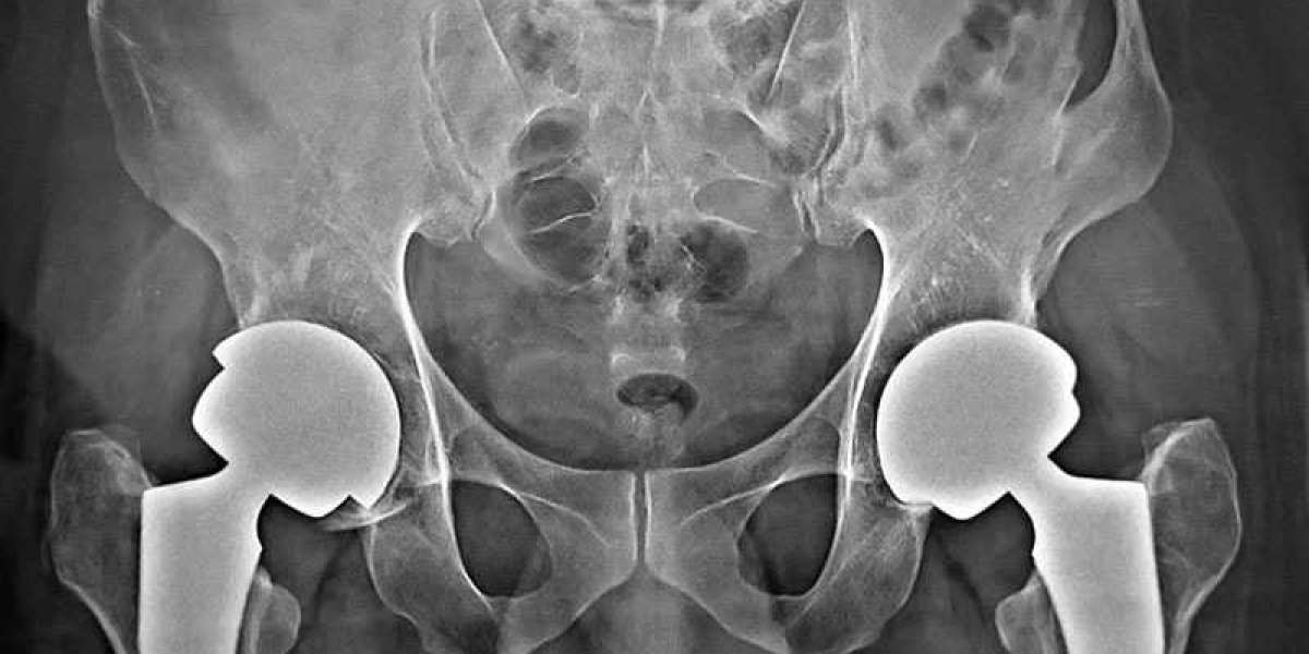 Comprehensive Guide to Hip Dysplasia and Advanced Total Hip Replacement Surgery in Delhi