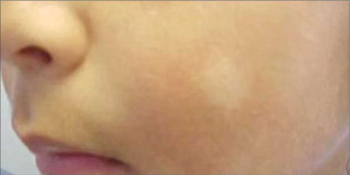 Vitiligo Treatment in India – Personalised Care at Kaya Kalp Global