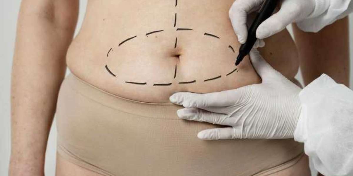 What Patients Often Overlook Before Liposuction Surgery